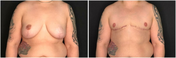 female-to-male-n-top-surgery-before-after-photo-los-angles-al-1-1