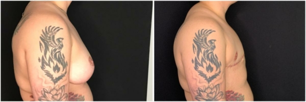 female-to-male-n-top-surgery-before-after-photo-los-angles-al-1-2