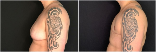 female-to-male-n-top-surgery-before-after-photo-los-angles-al-1-3