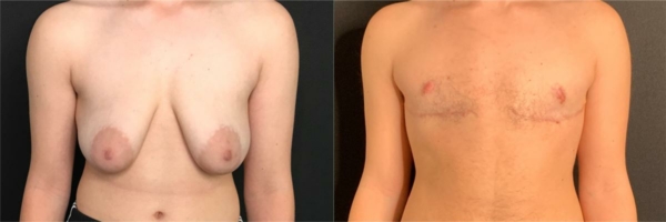 female-to-male-n-top-surgery-before-after-photo-los-angles-bs-1-1