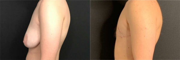 female-to-male-n-top-surgery-before-after-photo-los-angles-bs-1-2