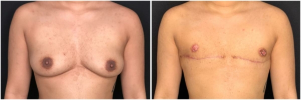 female-to-male-n-top-surgery-before-after-photo-los-angles-cb-1-1