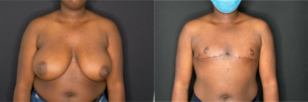 female-to-male-n-top-surgery-before-after-photo-los-angles-cj-1-1