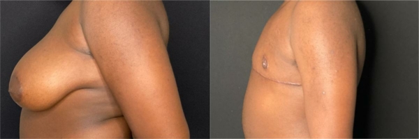 female-to-male-n-top-surgery-before-after-photo-los-angles-cj-1-2