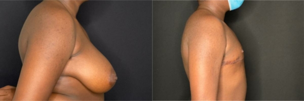 female-to-male-n-top-surgery-before-after-photo-los-angles-cj-1-3