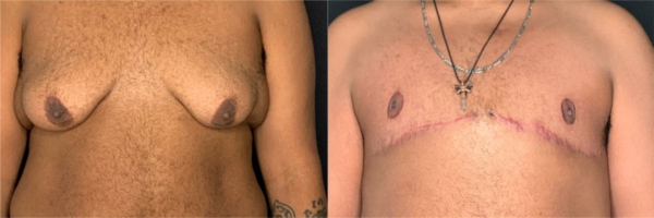 female-to-male-n-top-surgery-before-after-photo-los-angles-gw-1-1