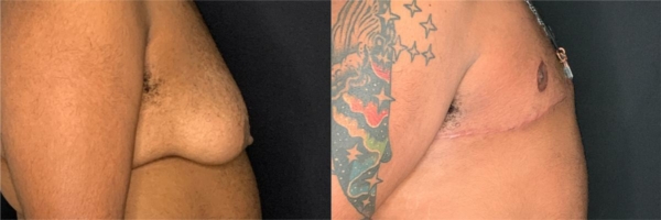 female-to-male-n-top-surgery-before-after-photo-los-angles-gw-1-2