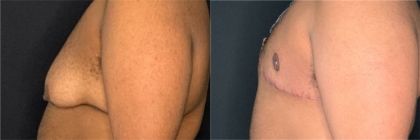 female-to-male-n-top-surgery-before-after-photo-los-angles-gw-1-3