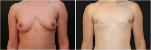 female-to-male-n-top-surgery-before-after-photo-los-angles-jf-1-1