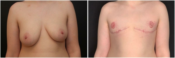 female-to-male-n-top-surgery-before-after-photo-los-angles-jl-1-1