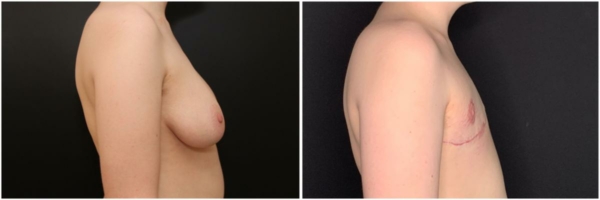 female-to-male-n-top-surgery-before-after-photo-los-angles-jl-1-2