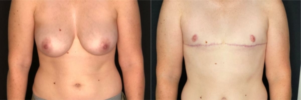 female-to-male-n-top-surgery-before-after-photo-los-angles-k-1-1