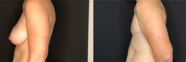 female-to-male-n-top-surgery-before-after-photo-los-angles-k-1-2