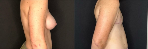 female-to-male-n-top-surgery-before-after-photo-los-angles-k-1-3