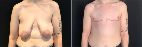 female-to-male-n-top-surgery-before-after-photo-los-angles-kb-1-1