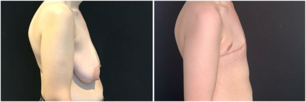 female-to-male-n-top-surgery-before-after-photo-los-angles-kb-1-2