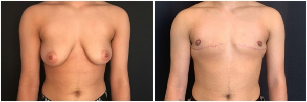 female-to-male-n-top-surgery-before-after-photo-los-angles-lf-1-1