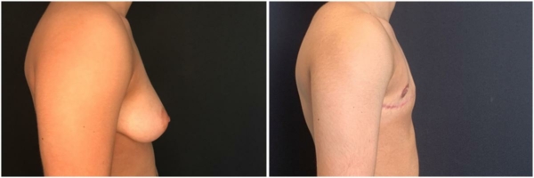 female-to-male-n-top-surgery-before-after-photo-los-angles-lf-1-2