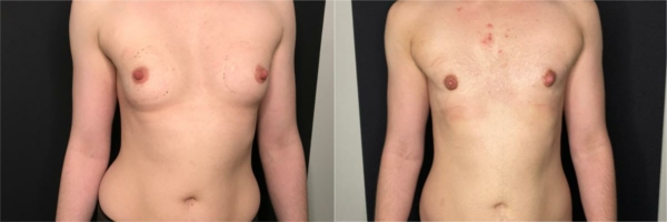 female-to-male-n-top-surgery-before-after-photo-los-angles-lj-1-1
