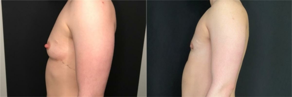 female-to-male-n-top-surgery-before-after-photo-los-angles-lj-1-2