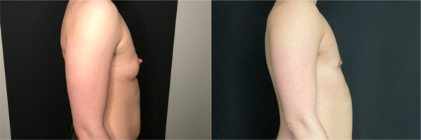 female-to-male-n-top-surgery-before-after-photo-los-angles-lj-1-3