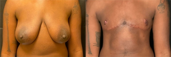 female-to-male-n-top-surgery-before-after-photo-los-angles-mc-1-1