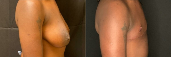 female-to-male-n-top-surgery-before-after-photo-los-angles-mc-1-2