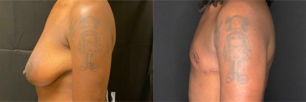 female-to-male-n-top-surgery-before-after-photo-los-angles-mc-1-3