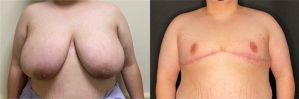 female-to-male-n-top-surgery-before-after-photo-los-angles-mt-1-1