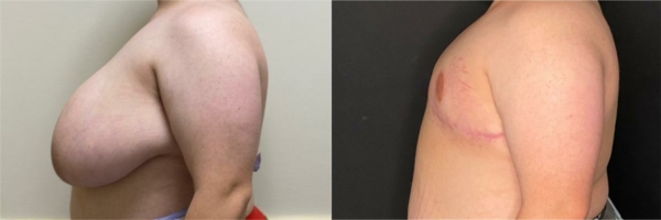 female-to-male-n-top-surgery-before-after-photo-los-angles-mt-1-2