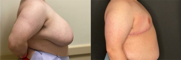 female-to-male-n-top-surgery-before-after-photo-los-angles-mt-1-3