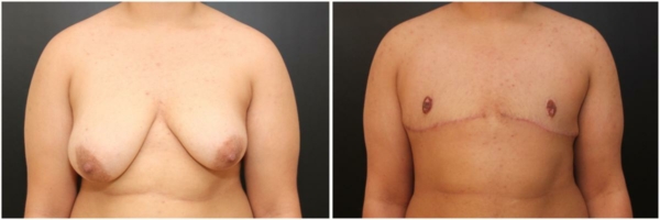 female-to-male-n-top-surgery-before-after-photo-los-angles-pd-1-1