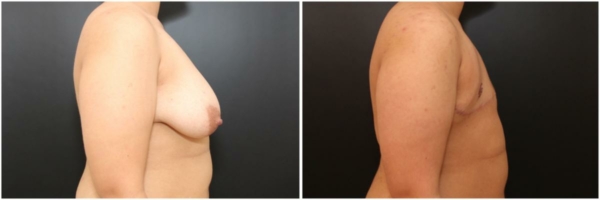 female-to-male-n-top-surgery-before-after-photo-los-angles-pd-1-2
