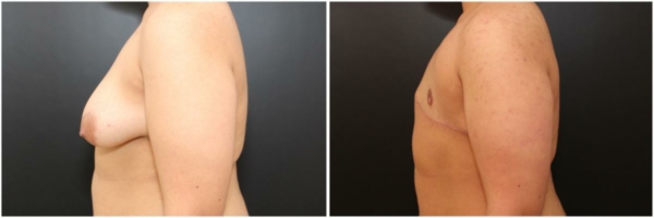 female-to-male-n-top-surgery-before-after-photo-los-angles-pd-1-3