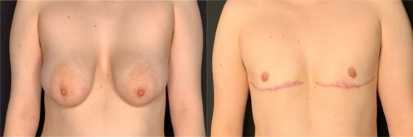 female-to-male-n-top-surgery-before-after-photo-los-angles-rl-1-1