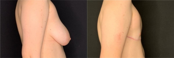 female-to-male-n-top-surgery-before-after-photo-los-angles-rl-1-2