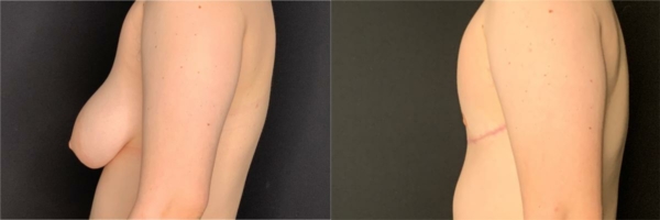 female-to-male-n-top-surgery-before-after-photo-los-angles-rl-1-3