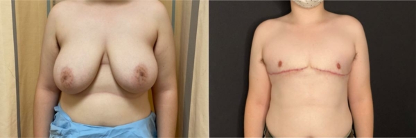 female-to-male-n-top-surgery-before-after-photo-los-angles-sl-1-1