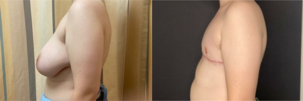 female-to-male-n-top-surgery-before-after-photo-los-angles-sl-1-2