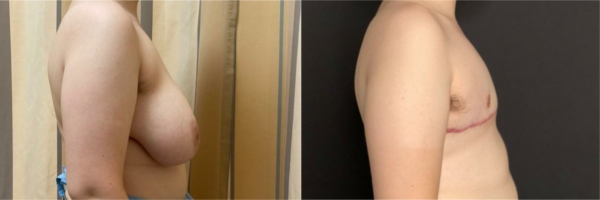 female-to-male-n-top-surgery-before-after-photo-los-angles-sl-1-3