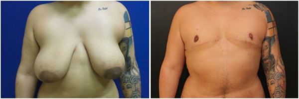 female-to-male-n-top-surgery-before-after-photo-los-angles-sm-1-1