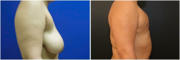 female-to-male-n-top-surgery-before-after-photo-los-angles-sm-1-2