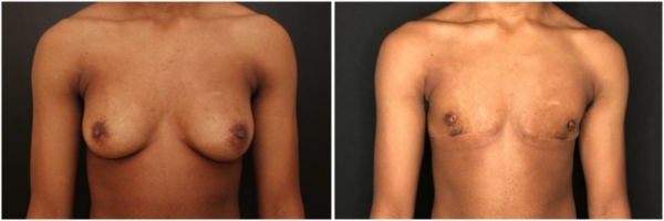 female-to-male-n-top-surgery-before-after-photo-los-angles-tj-1-1