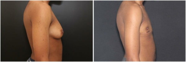 female-to-male-n-top-surgery-before-after-photo-los-angles-tj-1-2