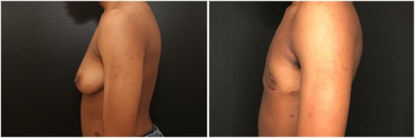 female-to-male-n-top-surgery-before-after-photo-los-angles-tj-1-3