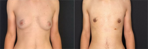 female-to-male-n-top-surgery-before-after-photo-los-angles-la-1-1
