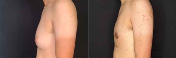 female-to-male-n-top-surgery-before-after-photo-los-angles-la-1-2