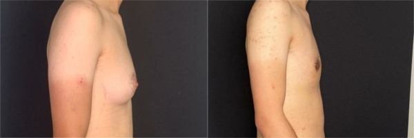 female-to-male-n-top-surgery-before-after-photo-los-angles-la-1-3