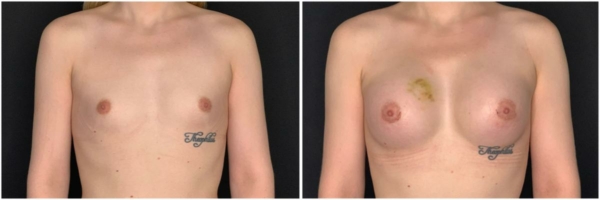 male-to-female-n-top-surgery-before-after-photo-los-angles-kk-1-1