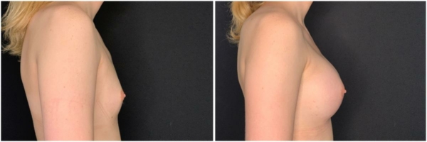 male-to-female-n-top-surgery-before-after-photo-los-angles-kk-1-2